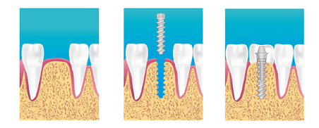 implant dentaire explication paris 2eme